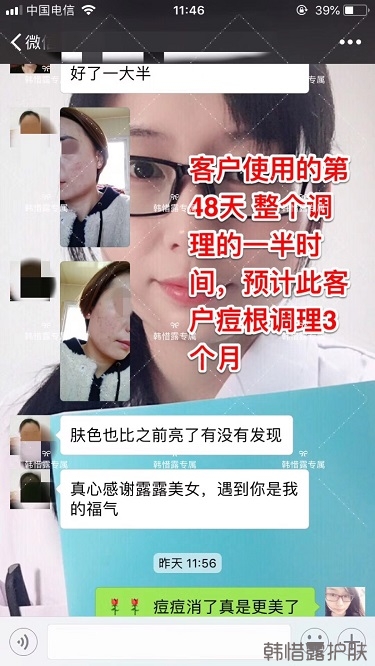 臉上一直長痘痘膿包怎么解決？痘痘開始消了，更美麗！